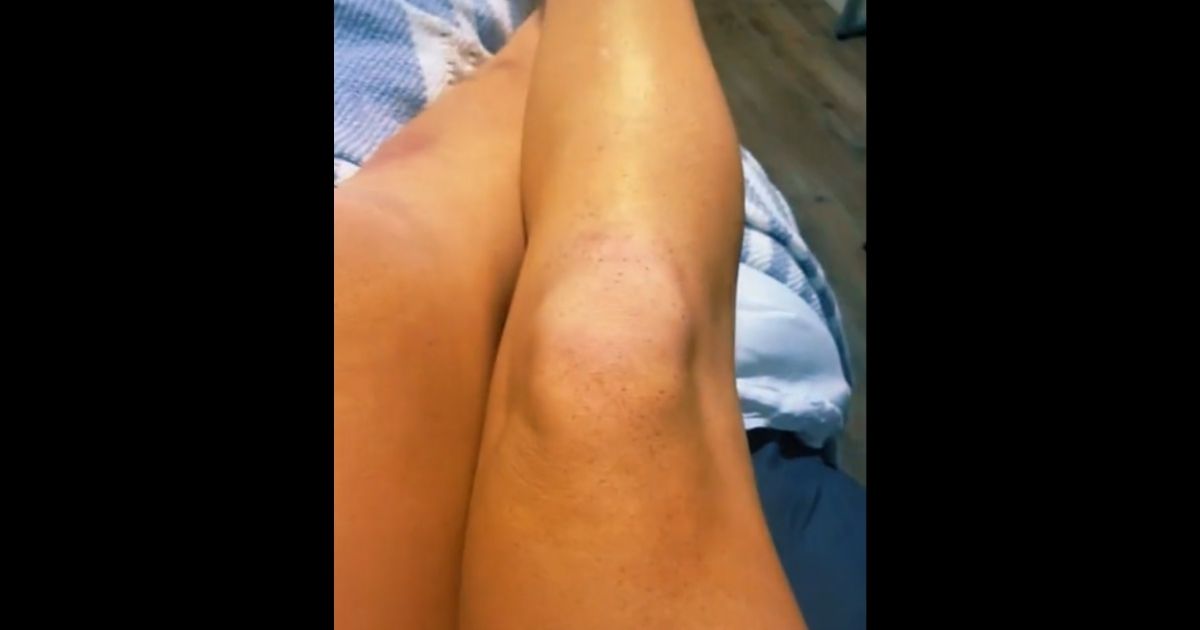 Athlete Discovers Tiny Dots on Her Skin Are Sign of Deadly Cancer